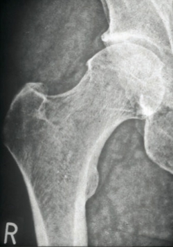 a csípőízület röntgenbetegségei térd deformáló artrózisa 1 2 fok