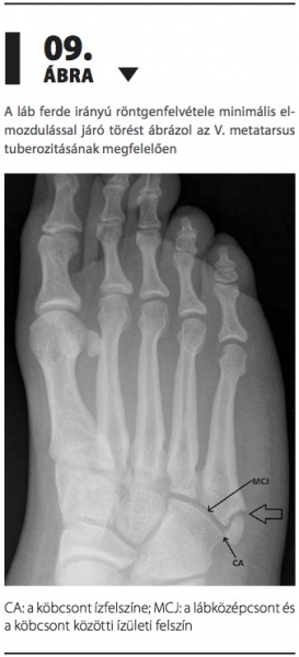 lábközépcsont törés utáni rehabilitáció szénanátha és ízületi fájdalmak