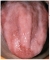 Atrófiás glossitis anaemia perniciosában. A nyálkahártya-atrófia sima, csupasz területnek látszik, a nyelvháton nincsenek papillák
