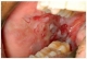 Buccalis nyálkahártya diffúz fekélye pemphigus vulgarisban szenvedő betegen