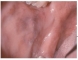 Kóros, diffúz melaninos pigmentáció Addison-kórban szenvedő beteg buccalis nyálkahártyáján. A beteg bőre is barnás színezetű
