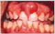 A gingiva diffúz erythemájával járó gingivitis, duzzanat és eltompult interdentális papillák cukorbetegségben. A szájüreg vizsgálata az íny és a fogak közötti tasakokra utalt, a röntgenvizsgálat súlyos alveoláris csontvesztést mutatott. Ezek a tünetek periodontitist valószínűsítenek
