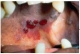 Idiopátiás purpura és vérzéses bullák thrombocytopeniás beteg szájpadjának nyálkahártyáján