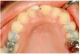 Károsodott fogzománc bulimiás beteg felső állcsontján, az elülső fogak lingualis felszínén. Ahogy a zománc vékonyodik, a fogak a felszínre kerülő dentin miatt sárgásnak tűnnek 11. ábra. A fogzománc eróziója a felső állcsont elülső fogainak lingualis felszínén gastro-oesophagealis reflux betegségben. A fogak a mélyebben lévő dentin felszínre kerülésével sárgásak lesznek. Ebben az esetben az erózió olyan súlyos mértékű volt, hogy a bal oldali első, felső metszőfognál fogcsatorna is megnyílt, ezért gyökérkeze