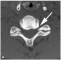 Axiális CT-felvételek a C5-C6 porckorongok szintjén egy krónikus nyakfájdalomban szenvedő betegnél. A csontszűrővel készült felvétel (a) a csigolyatest hátsó szegélye mentén osteophytákat mutat. Figyeljük meg a gerincvelőt tartalmazó foramen beszűkülését (nyíl). A lágyszövetszűrővel készült felvételen (b) kétoldalt a gerinccsatornát beszűkítő osteophyták láthatók (nyilak)