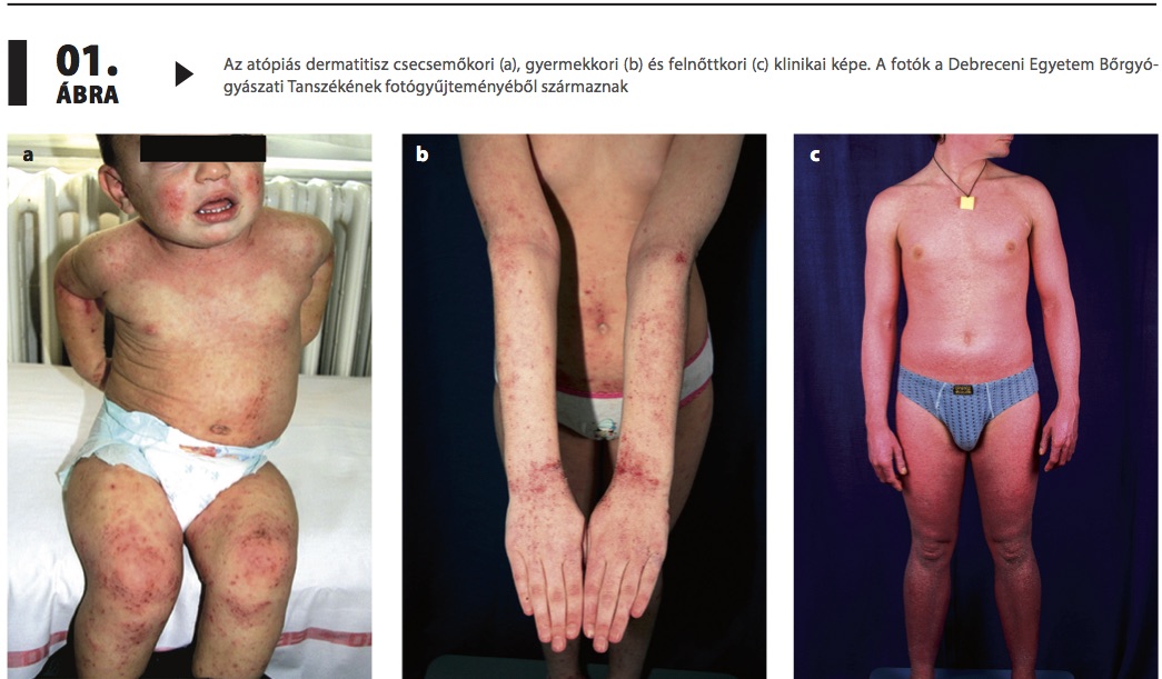 Atópiás dermatitis/Gyermekkori ekcéma