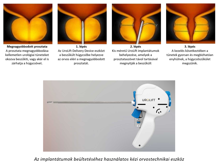 Egyszerű eszközök a prosztatitis kezelésére Prostatitis és klebsiella