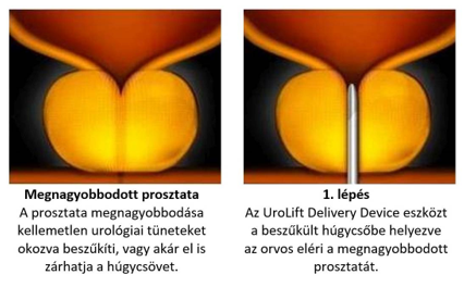 prostatitis az ábrán