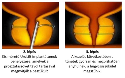 mi a prosztata hyperplasia transzuretrális reszekciója